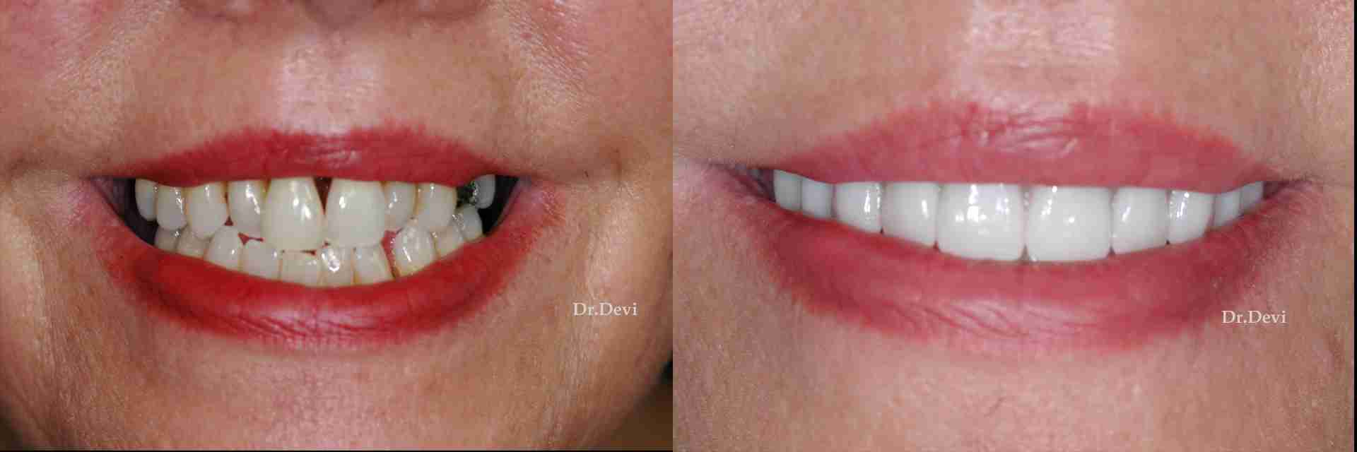 Transform Your Smile in a Flash with Same Day Dental Implant