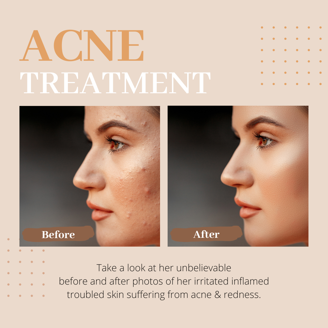 Is Accutane good for acne prone skin?