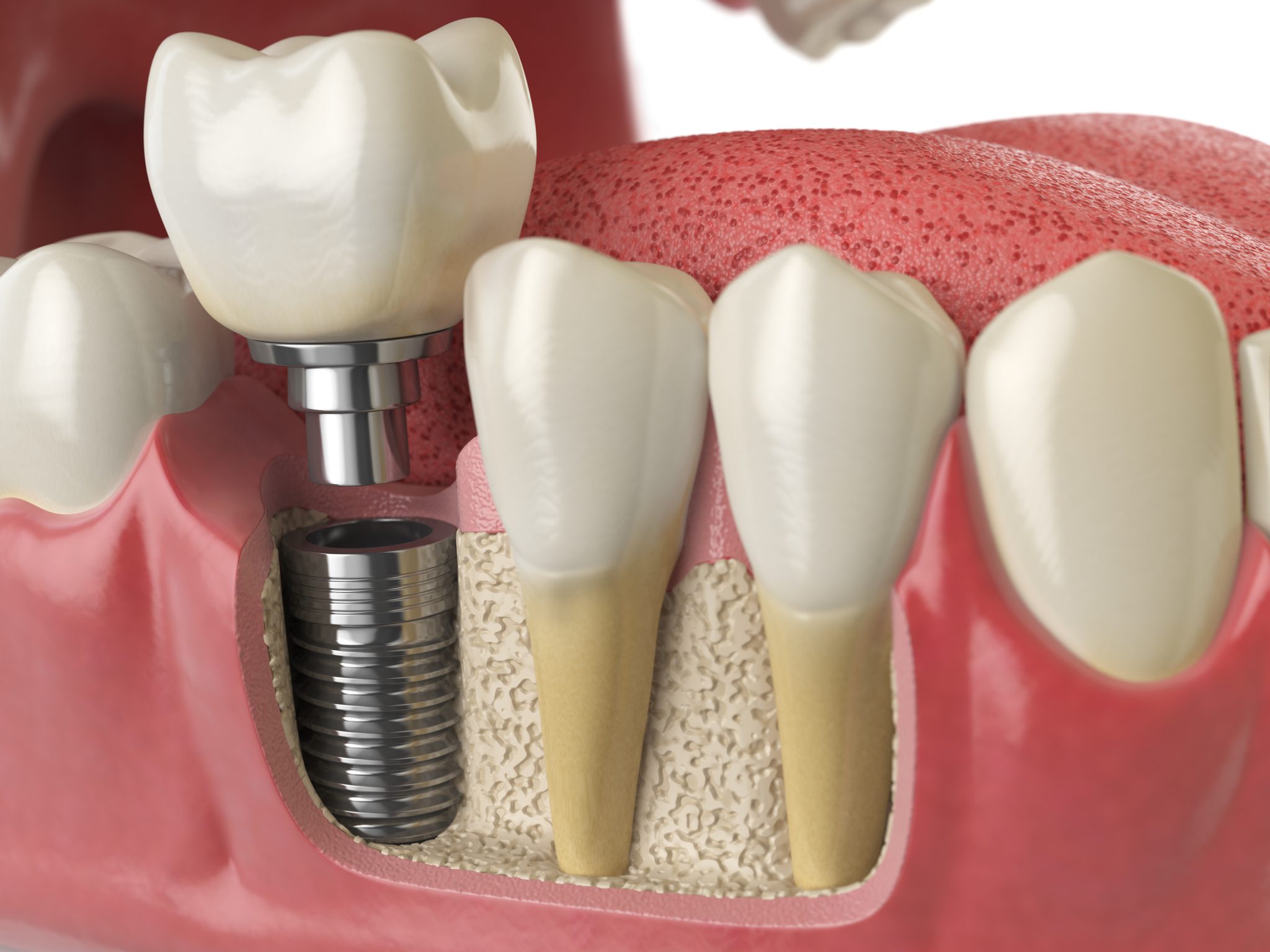Artificial Implants Market Growth Drivers, Trends, and Forecast – 2031
