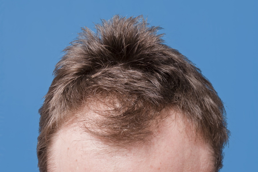 Tips to Cover and Treat Thinning Hair