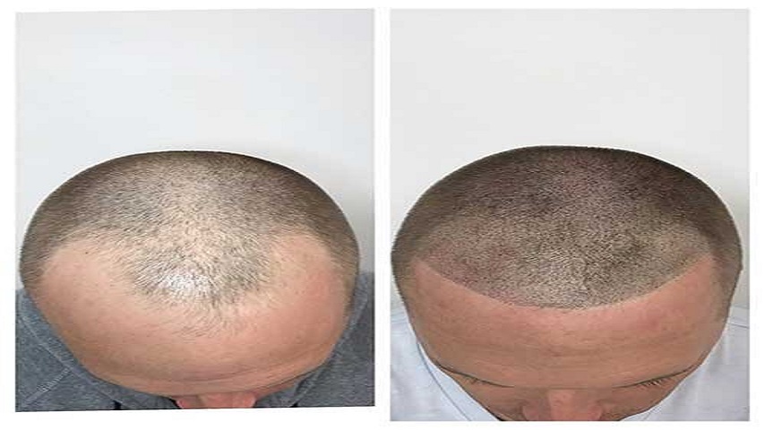 Strand Solutions: Non-Surgical Therapies for Tackling Hair Thinning
