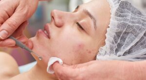 Top Acne Treatment