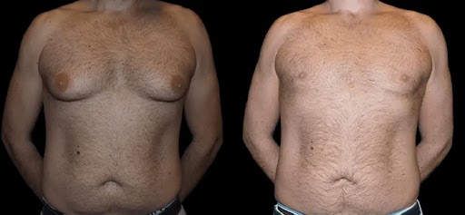 Male Breast Reduction for Adolescents: When is it Appropriate?