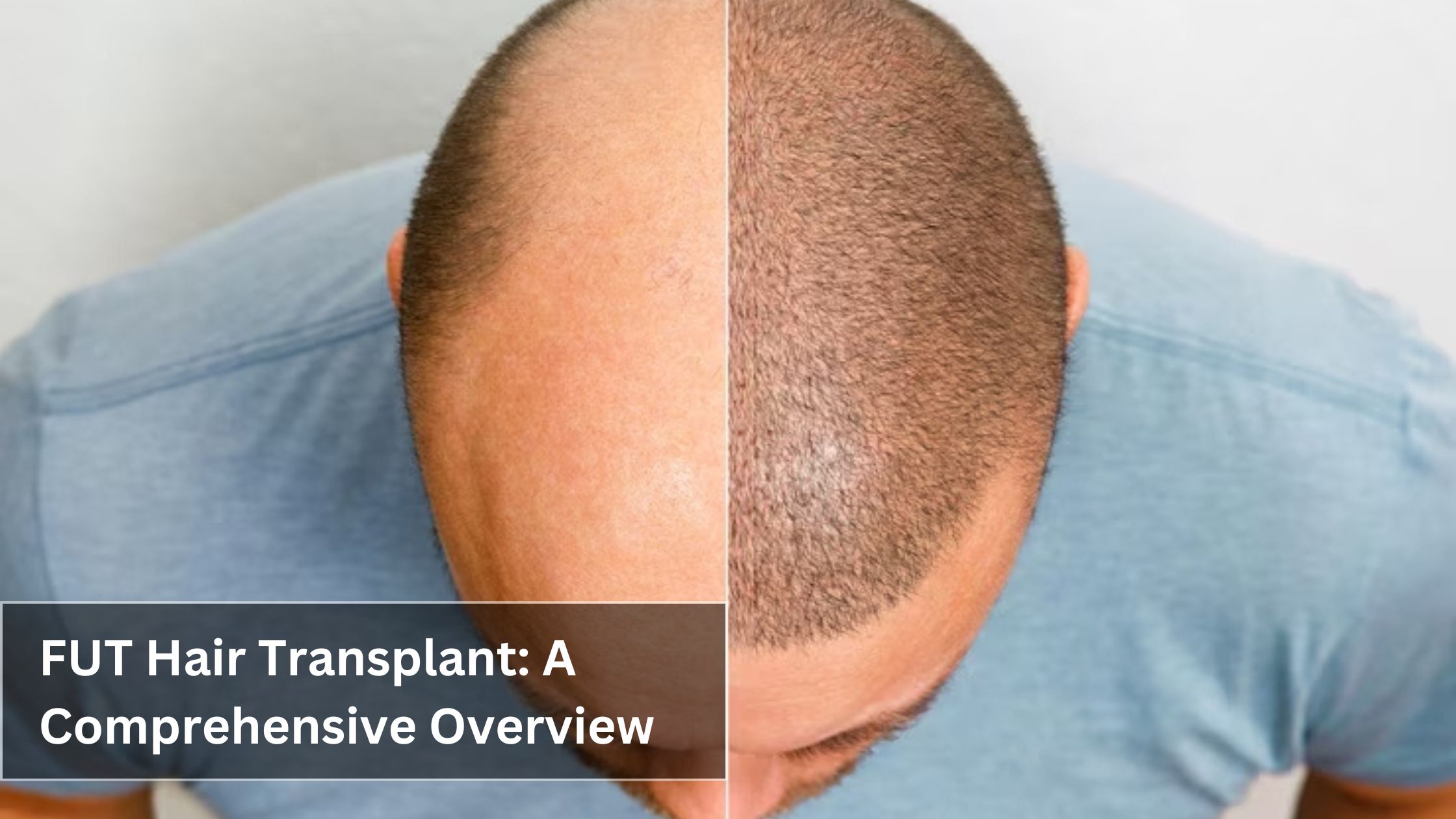 FUT Hair Transplant: A Comprehensive Overview