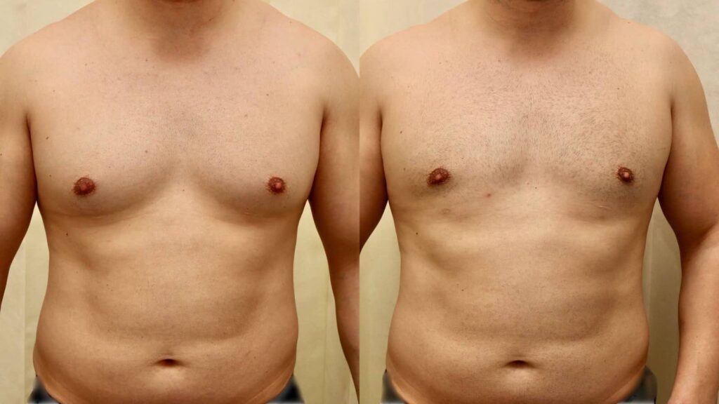 Gynecomastia Surgery for Teenagers: Is It Safe?