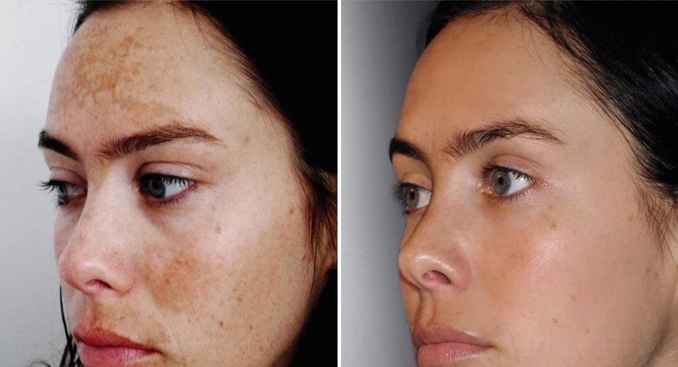 Pigmentation Treatment Kit: Your Ultimate Guide to Achieving